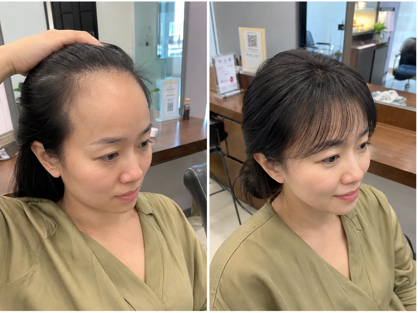 发际线后移顾客前额调整前后对比参考,观察额角和脸型比例